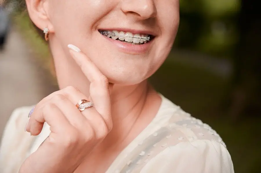 Types of Dental Braces