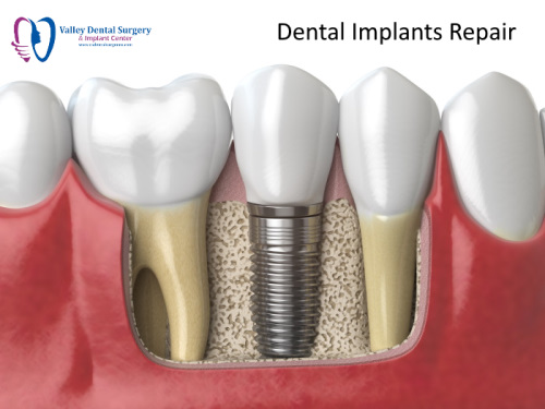 Repairing a Dental Implant